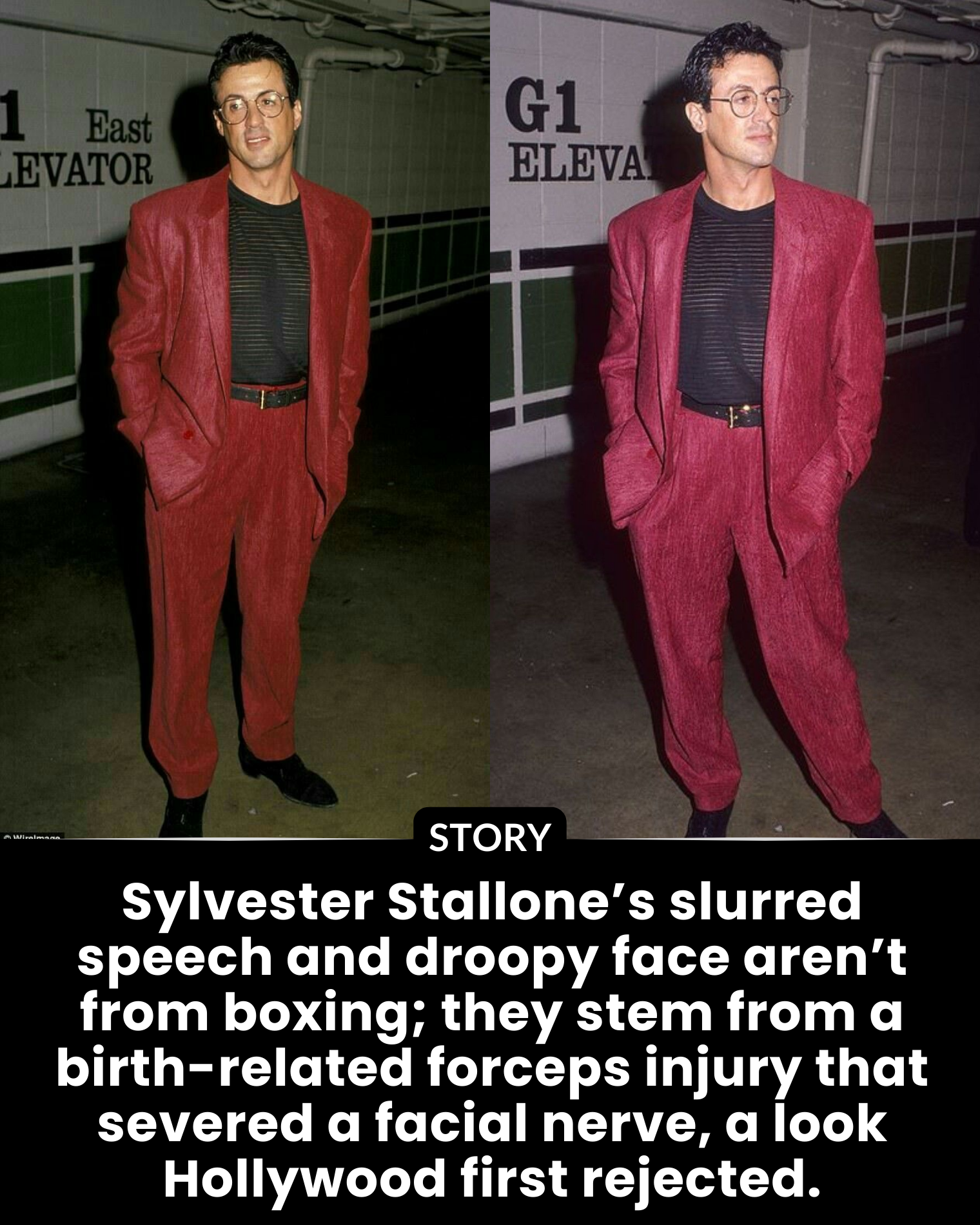 Sylvester Stallone’s slurred speech and droopy face aren’t from boxing; they stem from a birth-related forceps injury that severed a facial nerve, a look Hollywood first rejected.